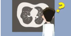肺肿瘤中的蛋白质水平可以预测预后改善治疗和诊断