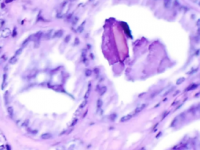 前列腺细胞的二维遗传图谱描绘了癌症的生长