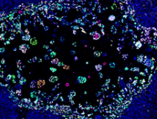 癌症研究空间基因组学的美好新世界