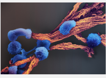 CART细胞癌免疫疗法变得个性化