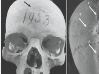 考古学家在中世纪妇女的头骨上发现了钻孔的证据
