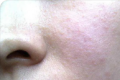 脸部皮肤过敏是什么原因