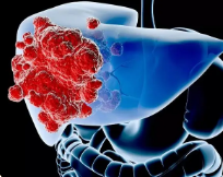 原发性肝癌晚期症状是什么