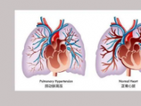 肺动脉高压分级