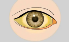 眼睛白眼球发黄是怎么回事