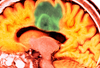 超声波让化疗药物进入人脑