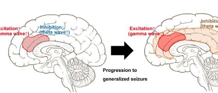 新研究显示突触可塑性在调节癫痫患者脑功能中的关键作用