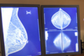 已鉴定出可预防难以治疗的乳腺癌的蛋白质