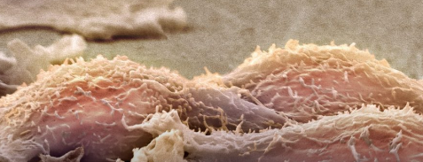 癌细胞转变为肌肉细胞有可能实现分化治疗