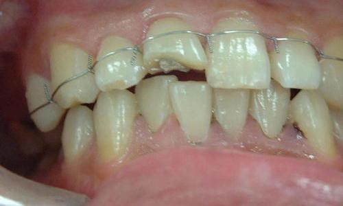 牙齿松动怎么样修复 牙齿松了怎么让它长紧